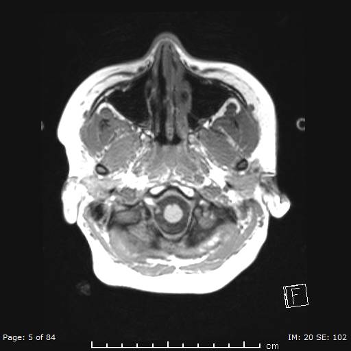 File:Balo concentric sclerosis (Radiopaedia 61637-69636 Axial T1 5).jpg