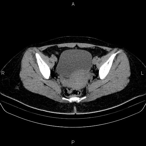 Bartholin gland cyst (Radiopaedia 62635-70930 Axial non-contrast 49).jpg