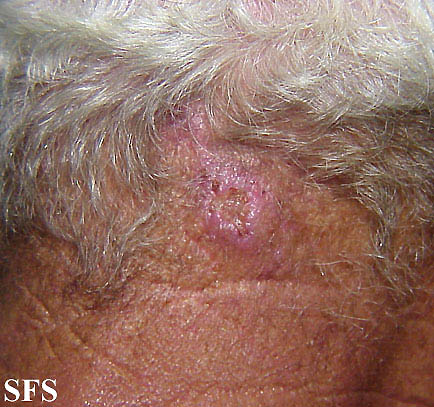 Basal Cell Carcinoma (Dermatology Atlas 70).jpg