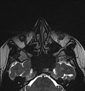 Basal cell carcinoma - nasal region (Radiopaedia 70292-80365 Axial Gradient Echo 51).jpg