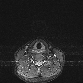 File:Basal cell carcinoma - nasal region (Radiopaedia 70292-80365 Axial STIR 34).jpg