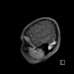 Base of skull rhabdomyosarcoma (Radiopaedia 32196-33142 J 53).jpg
