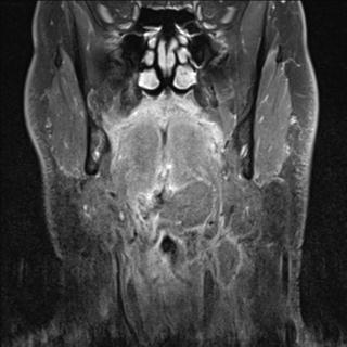 File:Base of tongue squamous cell carcinoma (Radiopaedia 31174-31884 E 10).jpg