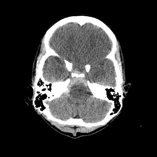 File:Basilar artery perforator aneurysm (Radiopaedia 82455-96597 Axial non-contrast 8).jpg