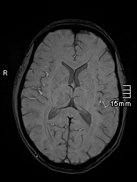 File:Basilar artery perforator aneurysm (Radiopaedia 82455-99523 Axial SWI 36).jpg
