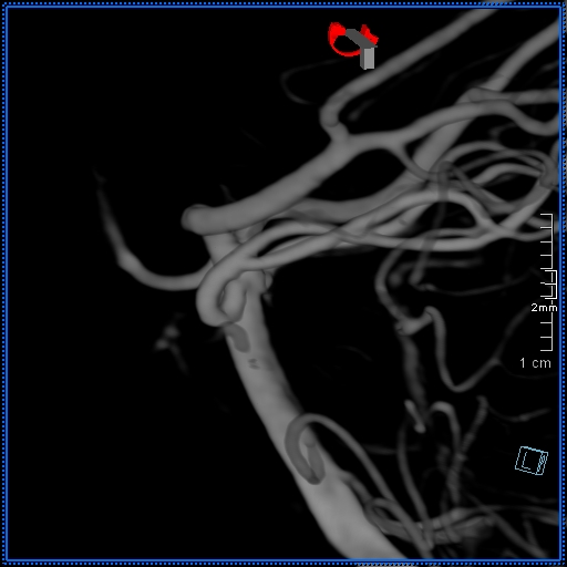 Basilar artery perforator aneurysm (Radiopaedia 82455-99524 3D Left VA 17).jpg