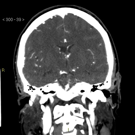 File:Basilar artery thrombosis (Radiopaedia 16260-15944 B 30).jpg