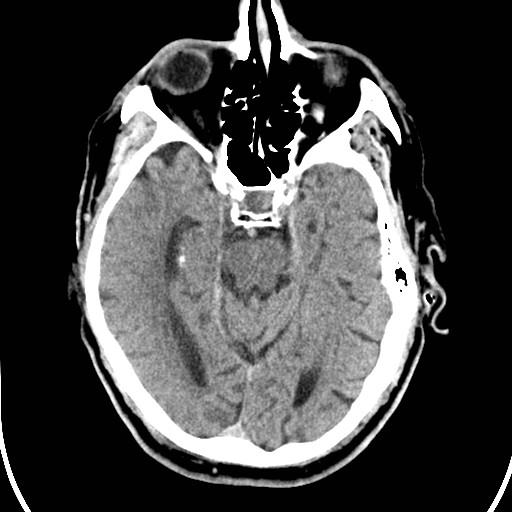 File:Basilar artery thrombosis (Radiopaedia 26986-27162 Axial non-contrast 12).jpg