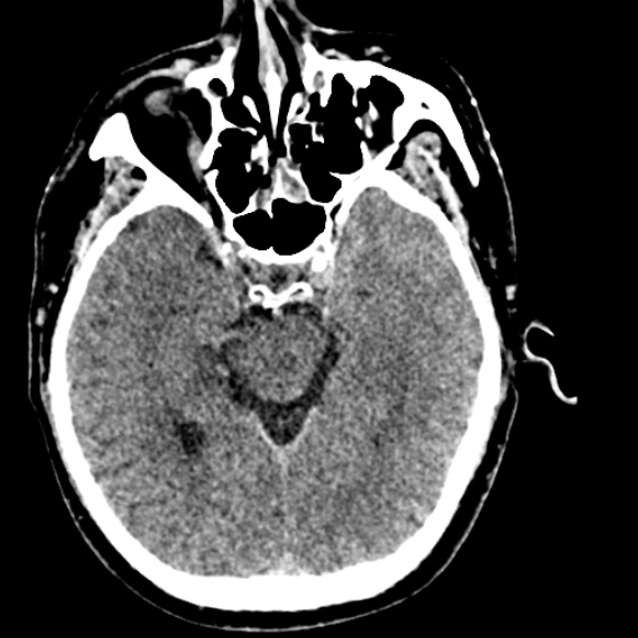 Basilar artery thrombosis (Radiopaedia 53351-59333 Axial non-contrast 54).jpg