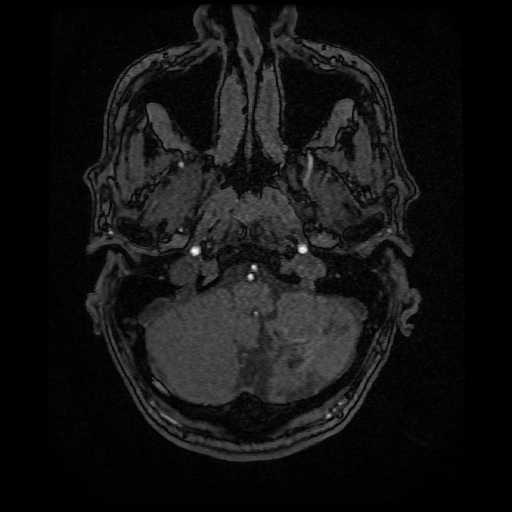 Basilar top and left middle cerebral artery aneurysm (Radiopaedia 61965-70031 Axial MRA 12).jpg