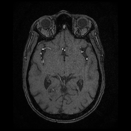 Basilar top and left middle cerebral artery aneurysm (Radiopaedia 61965-70031 Axial MRA 74).jpg