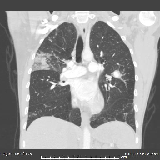 File:Behçet disease (Radiopaedia 44247-47889 Coronal lung window 32).jpg