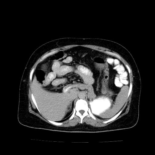 File:Benign spindle cell tumor - abdominopelvic (Radiopaedia 61300-69212 Axial C+ delayed 16).jpg