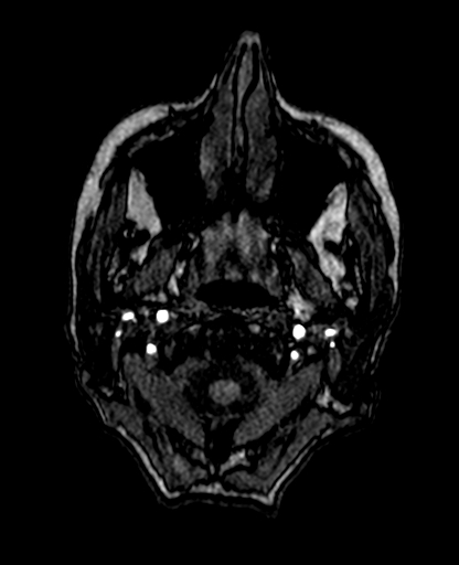 Berry aneurysm of the terminal internal carotid artery (Radiopaedia 88286-104918 Axial TOF 20).jpg