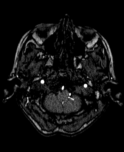 File:Berry aneurysm of the terminal internal carotid artery (Radiopaedia 88286-104918 Axial TOF 52).jpg