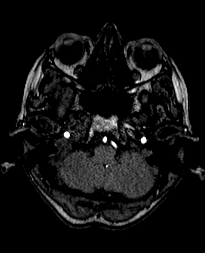 Berry aneurysm of the terminal internal carotid artery (Radiopaedia 88286-104918 Axial TOF 60).jpg