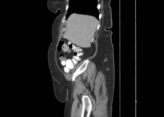 Bicameral celiacomesenteric aneurysm (Radiopaedia 55766-62327 B 11).jpg