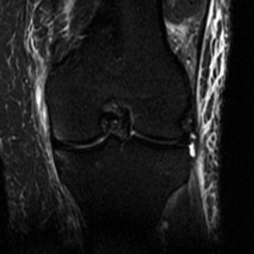 File:Biceps femoris distal tendon avulsion (Radiopaedia 15109-14987 Coronal STIR 3).jpg