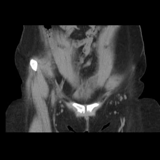 File:Bicornuate uterus- on MRI (Radiopaedia 49206-54296 Coronal non-contrast 2).jpg