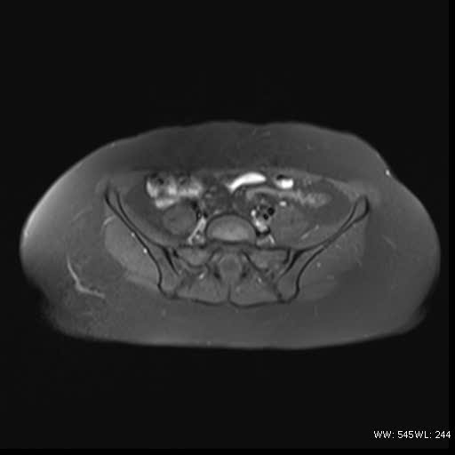 File:Bicornuate uterus- on MRI (Radiopaedia 49206-54297 Axial T1 fat sat 4).jpg