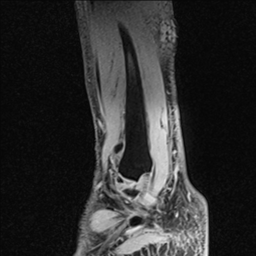 Bilateral Achilles tendon complete tear (Radiopaedia 81344-95051 Sagittal WE - Right 26).jpg