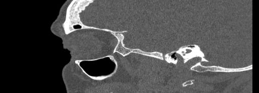 File:Bilateral Ectopic Infraorbital Nerves (Radiopaedia 49006-54084 Sagittal bone window 44).jpg