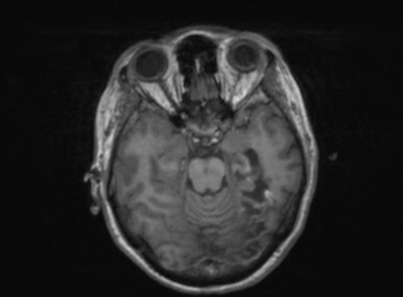 Bilateral PCA territory infarction - different ages (Radiopaedia 46200-51784 Axial T1 274).jpg