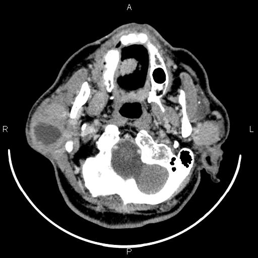 Bilateral Warthin tumors (Radiopaedia 84034-99263 Axial With contrast 16).jpg