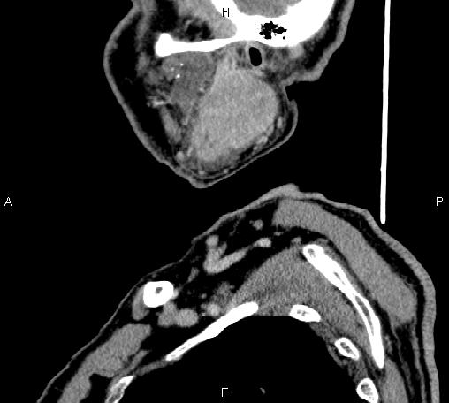 Bilateral Warthin tumors (Radiopaedia 84034-99263 D 65).jpg