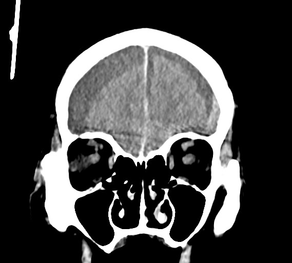 Bilateral acute on chronic subdural hematomas (Radiopaedia 78466-91146 Coronal non-contrast 17).jpg