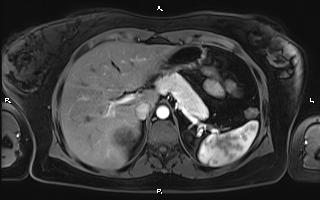 Bilateral adrenal myelolipoma (Radiopaedia 63058-71537 Axial T1 C+ fat sat 29).jpg