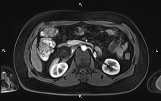 Bilateral adrenal myelolipoma (Radiopaedia 63058-71537 Axial T1 C+ fat sat 48).jpg