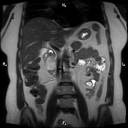 File:Bilateral adrenal myelolipoma (Radiopaedia 63058-71537 Coronal T2 17).jpg