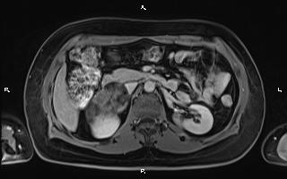 File:Bilateral adrenal myelolipoma (Radiopaedia 63058-71537 H 46).jpg
