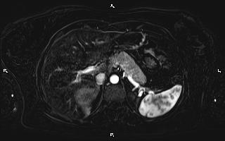 Bilateral adrenal myelolipoma (Radiopaedia 63058-71537 I 29).jpg