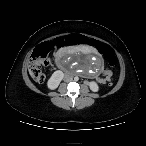 Bilateral adrenal thrombosis (Radiopaedia 58182-65256 A 39).jpg