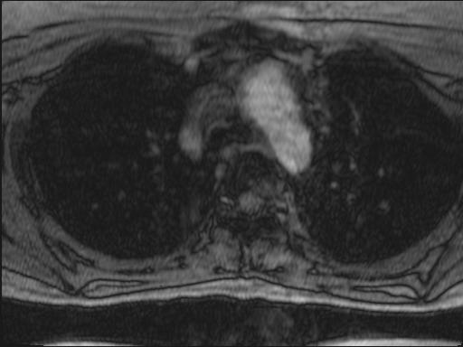 File:Bilateral carotid body tumors and right jugular paraganglioma (Radiopaedia 20024-20060 Axial 262).jpg