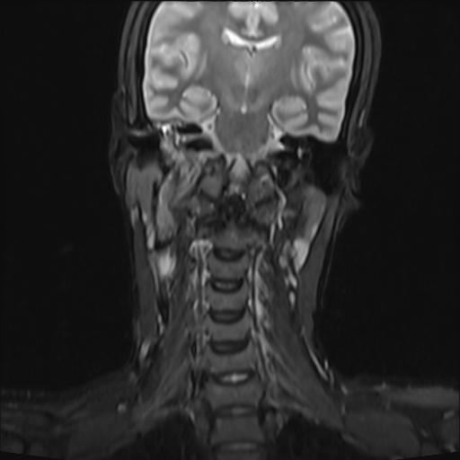 File:Bilateral carotid body tumors and right jugular paraganglioma (Radiopaedia 20024-20060 Coronal 31).jpg