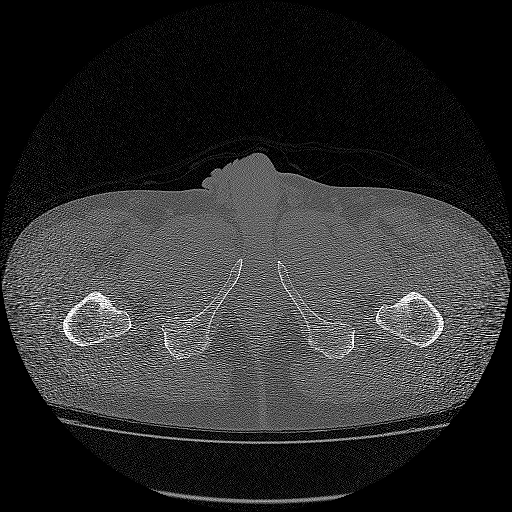 Bilateral femoral neck stress fractures (Radiopaedia 28666-28954 Axial bone window 87).png
