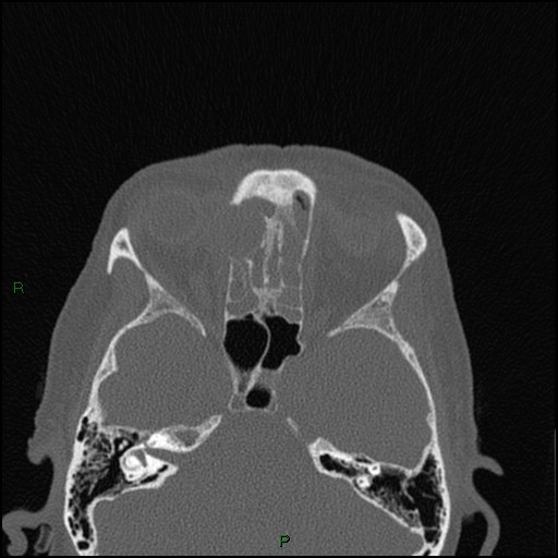Bilateral frontal mucoceles (Radiopaedia 82352-96454 Axial bone window 133).jpg