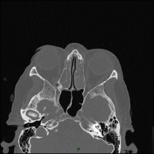 Bilateral frontal mucoceles (Radiopaedia 82352-96454 Axial bone window 150).jpg