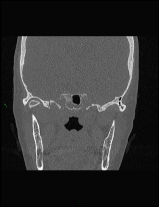 Bilateral frontal mucoceles (Radiopaedia 82352-96454 Coronal 261).jpg