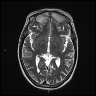 File:Bilateral frontal mucoceles (Radiopaedia 82352-96455 Axial T2 10).jpg