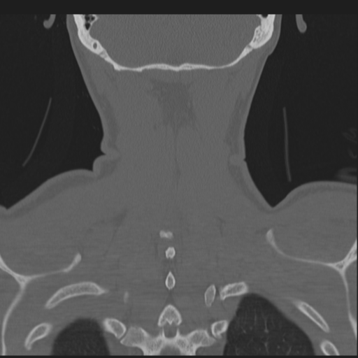 Bilateral locked facets (Radiopaedia 33850-35016 Coronal bone window 76).png