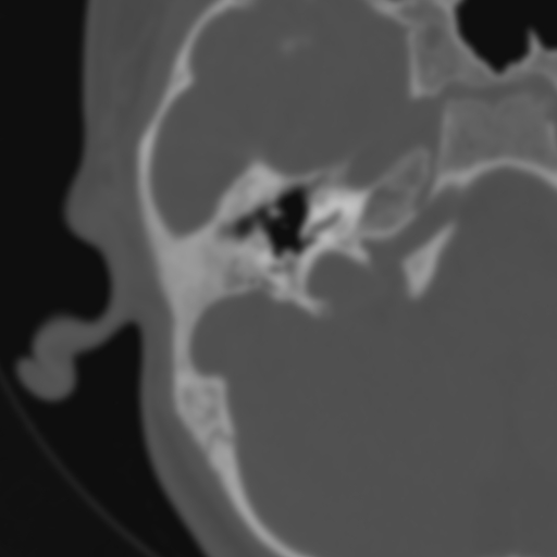 Bilateral otosclerosis (Radiopaedia 57237-64157 B 51).jpg