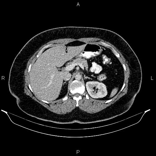 Bilateral ovarian dermoid cysts (Radiopaedia 85785-101603 A 35).jpg