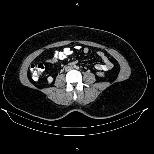 Bilateral ovarian dermoid cysts (Radiopaedia 85785-101603 A 62).jpg