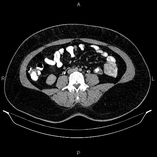 File:Bilateral ovarian dermoid cysts (Radiopaedia 85785-101603 Axial C+ delayed 43).jpg