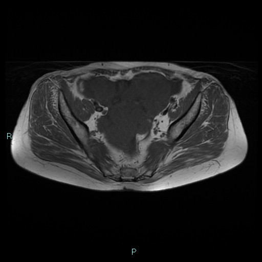 File:Bilateral ovarian fibroma (Radiopaedia 44568-48293 Axial T1 12).jpg
