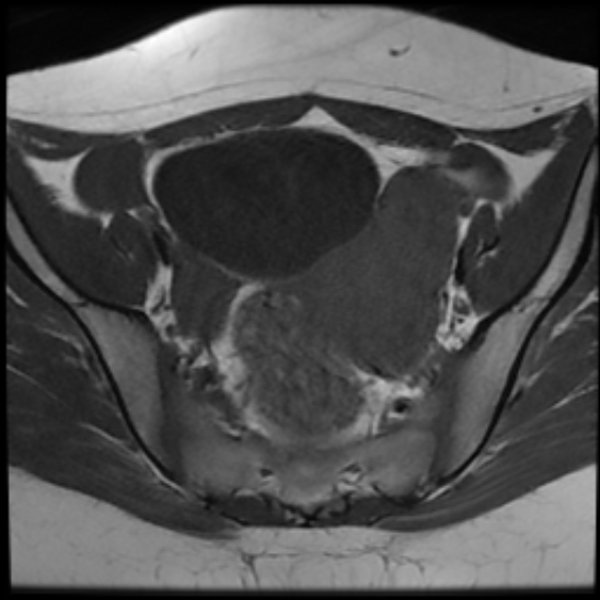 File:Bilateral ovarian fibrothecomas - adolescent (Radiopaedia 86604-102707 Axial T1 13).jpg